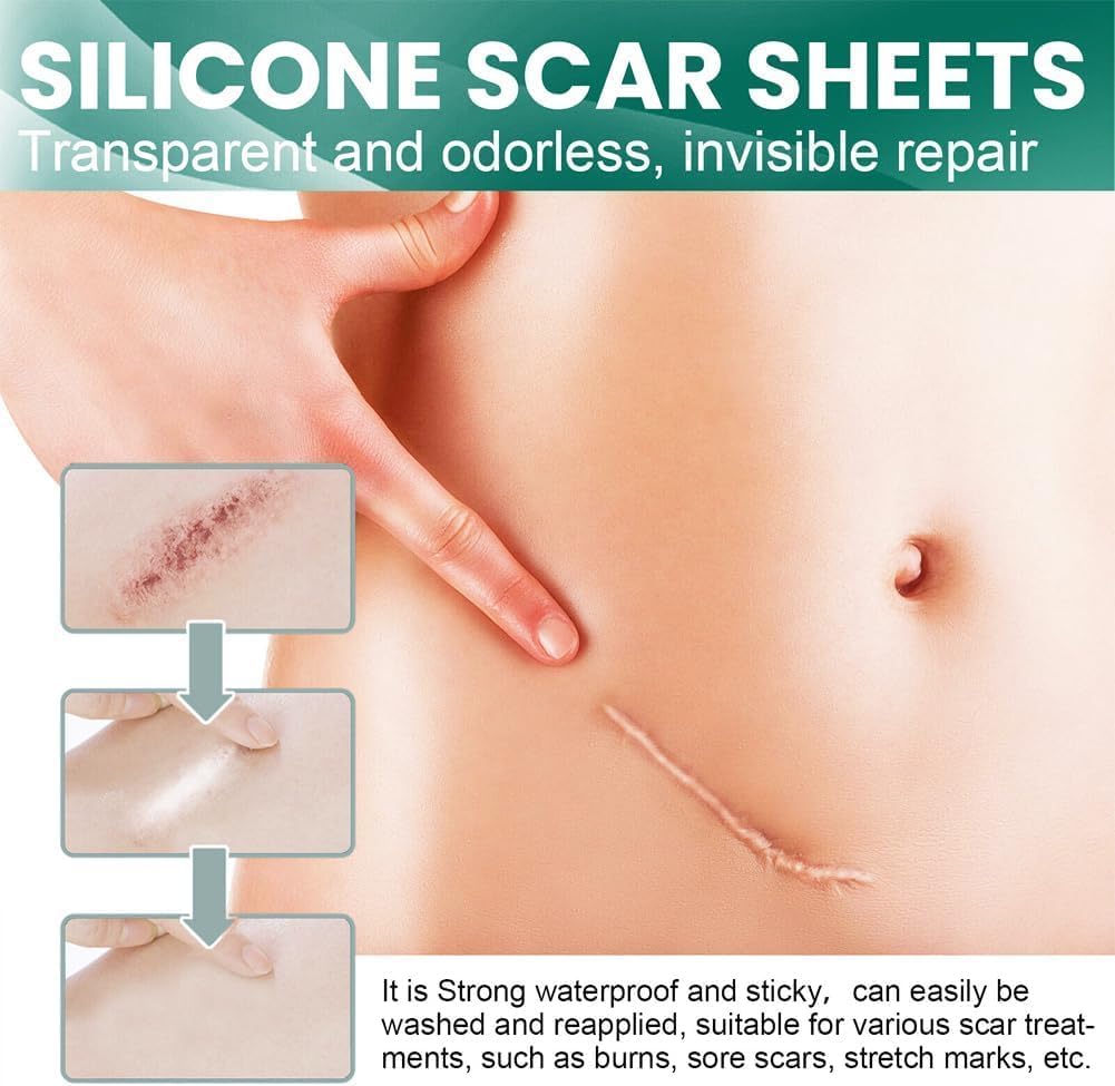 SKY-TOUCH Silicone Scar Sheets,Extra Long Scar Sheets for C-Section, Tummy Tuck, Keloid, and Surgical Scars - Reusable Medical Grade Silicone Scar Tape(4 x 150cm/2 Rolls) - 2